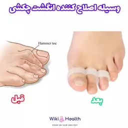 وسیله اصلاح کننده انگشت چکشی پا  (hammer toe) (طب و صنعت) (ویکی هلث)