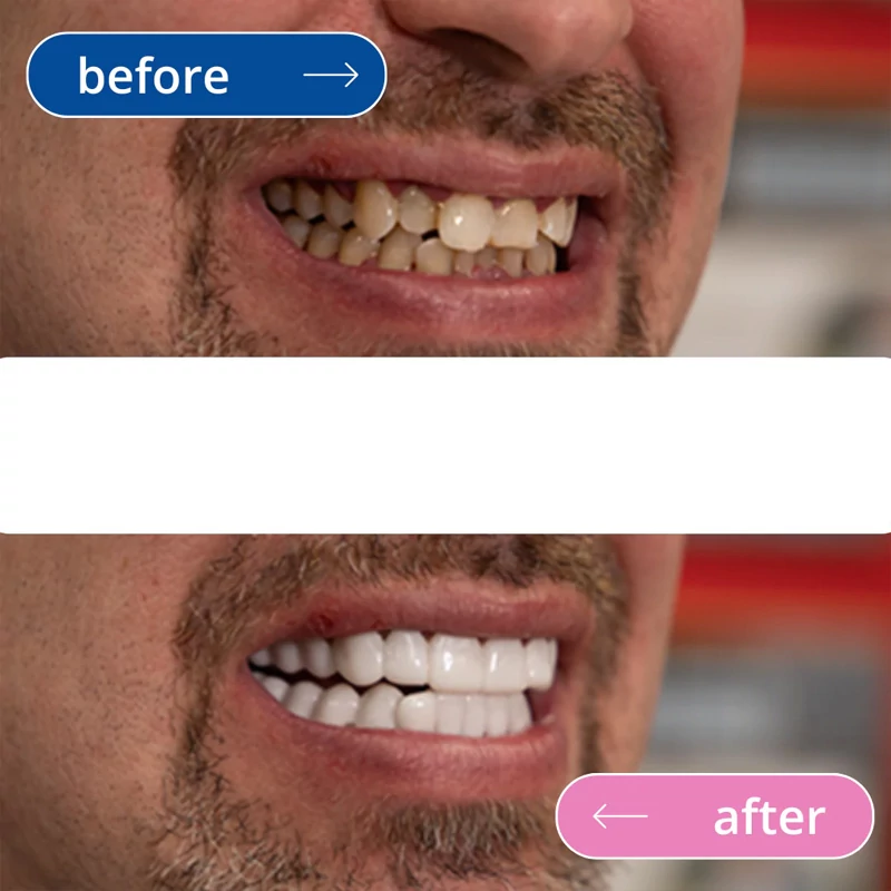 لمینت متحرک دندان دو فک