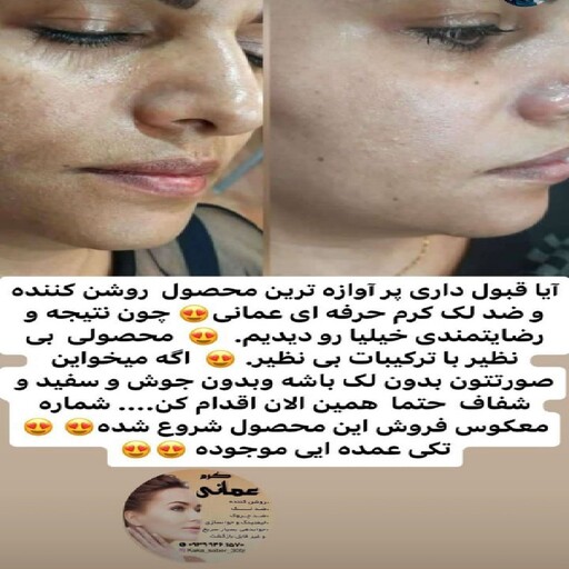 کرم سفید کننده صورت  ضد لک و ضد جوش عمانی تضمینی بدون هیچ گونه عوارضی 