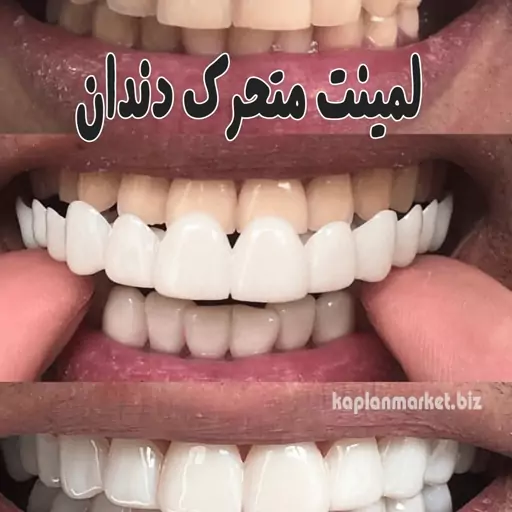 لمینت متحرک دندان  ترو اسمایل دو فک اصلی True Smile