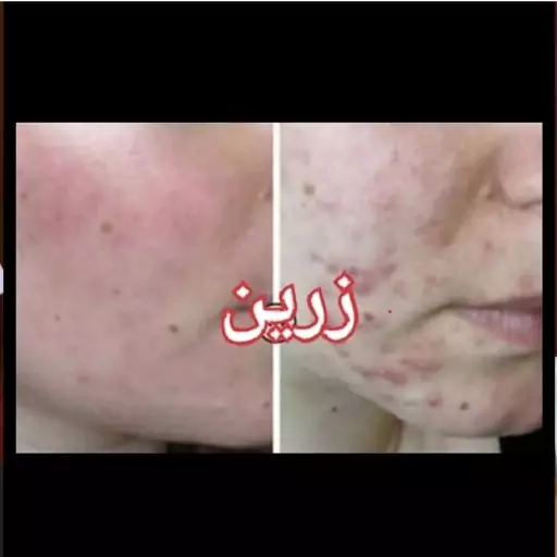 پک کامل پاکسازی جوش زرین