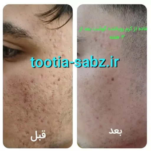 کرم گودی و حفره جای جوش و بخیه و...