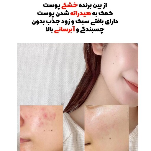 سرم بسیار قوی مخصوص جای جوش قرمز