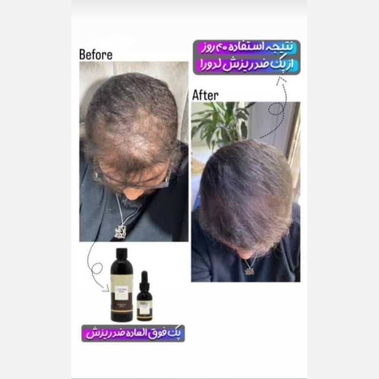 پک ضدریزش آقایان