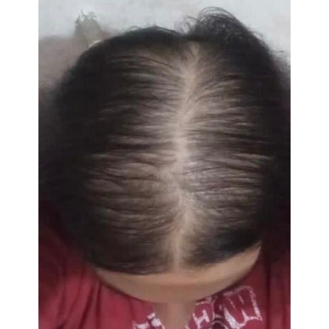 قطع دائمی ریزش مو تا پرپشتی مو