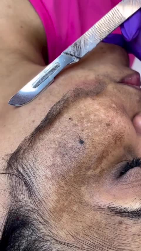 بسته 10 عددی تیغ درماپلنینگ