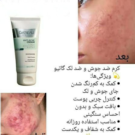 کرم ژل آنتی آکنه 40 میل گاتیو (ضد جوش و ضد لک)