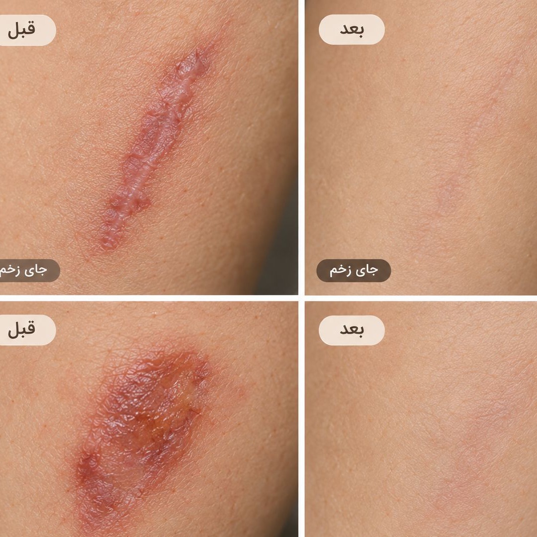 کرم ترمیمکننده جای زخم و اسکار لانبنا LANBENA مدل Scar Removal Cream حجم 30 گرمجدید