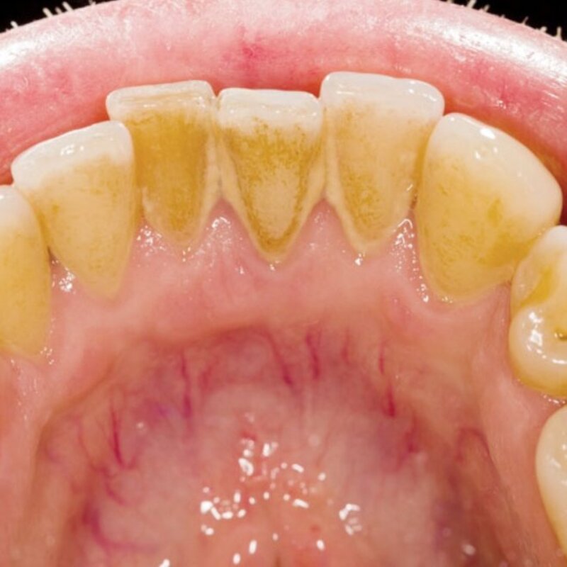 جرم گیر طبیعی دندان آذربه جایگزین بلیچینگ و جرم گیری 