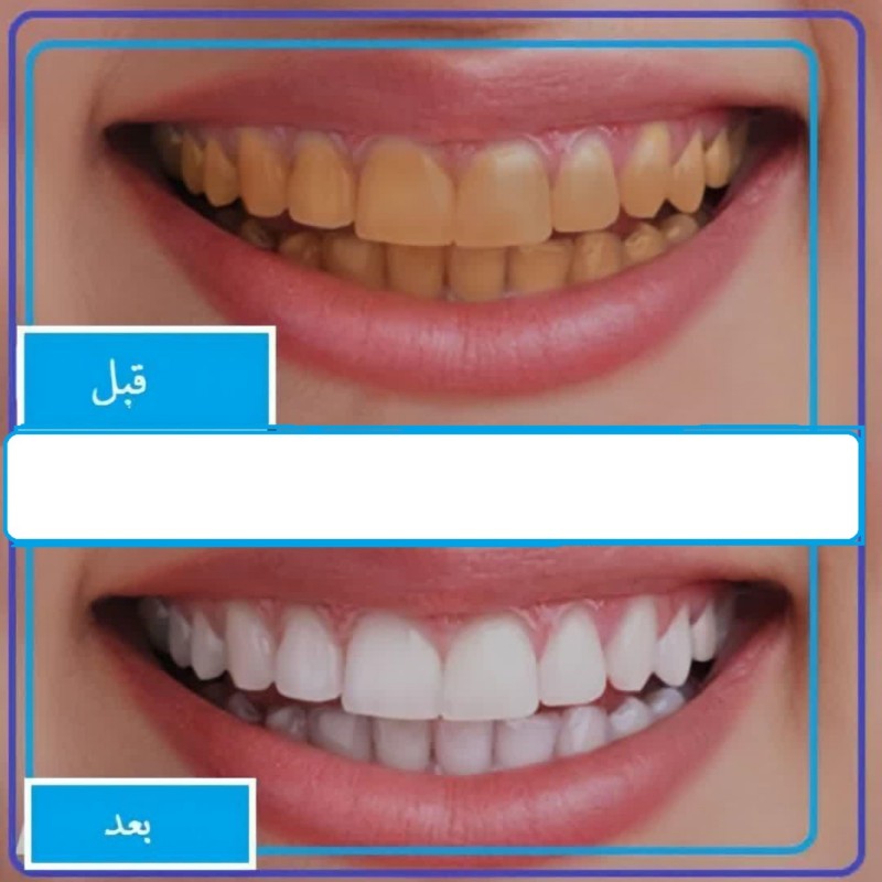 سفید کننده دندان رازوک و آرال (پودر)