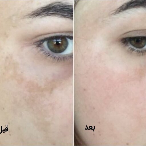 کرم ضدلک تخصصی طبیعی گیاهی روشن کننده بدون ذره ای ماده شیمیایی