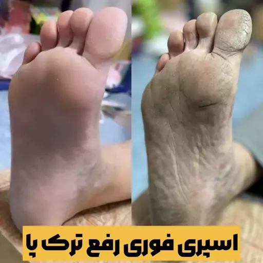 اسپری ترک پا  150 میل لایه بردار رفع خشکی پا و نرم کننده