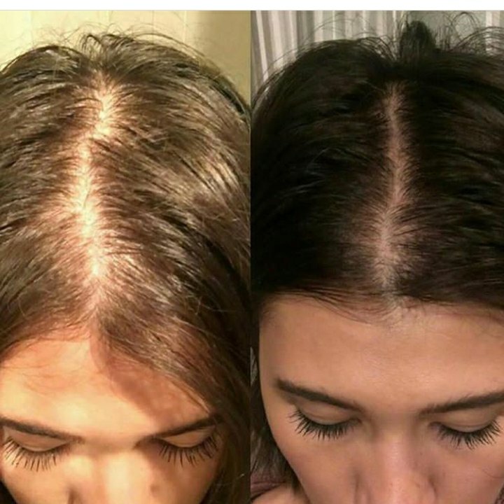 اکسیرضد ریزش و  تقویت کننده  مو 