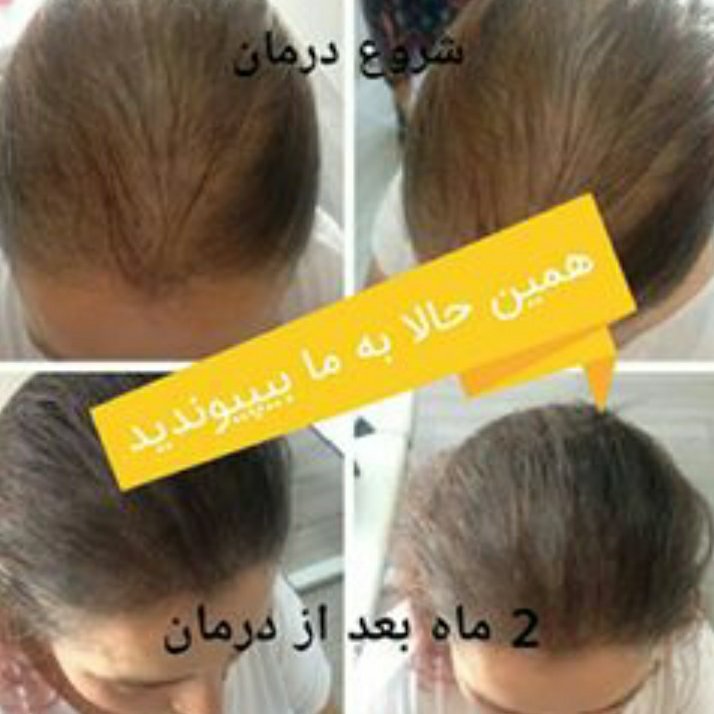 اکسیرضد ریزش و  تقویت کننده  مو 