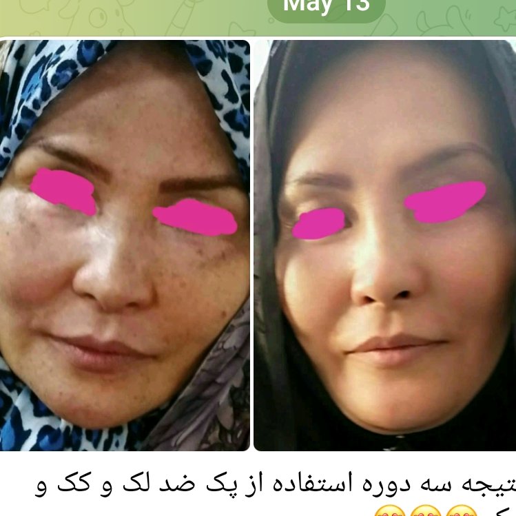 کرم ضد لک تخصصی سیمرغ آذین 2ماهه