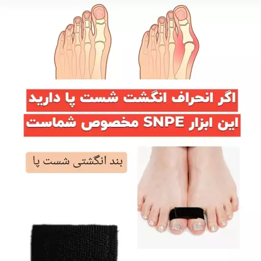 بند انگشتی شست پا snpe