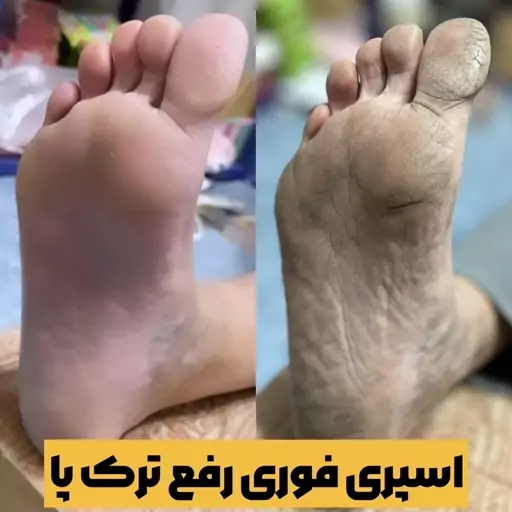 اسپری ترک پا راکو  لایه بردار و جوانسازی پا