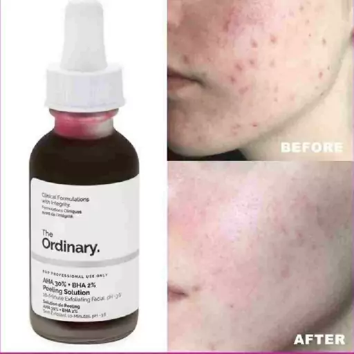 سرم اوردینری AHA 30 + BHA 2 ،لایه بردار قوی The Ordinary AHA 30 + BHA 2 Peeling Solutio