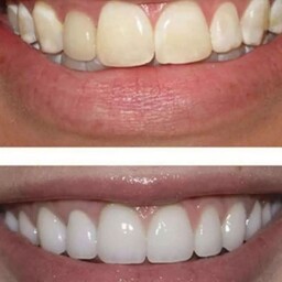 پودر  سفید کننده دندان 