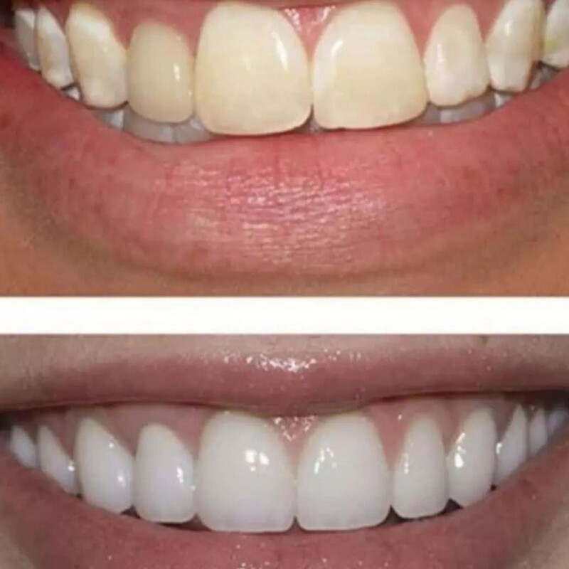 پودر  سفید کننده دندان 