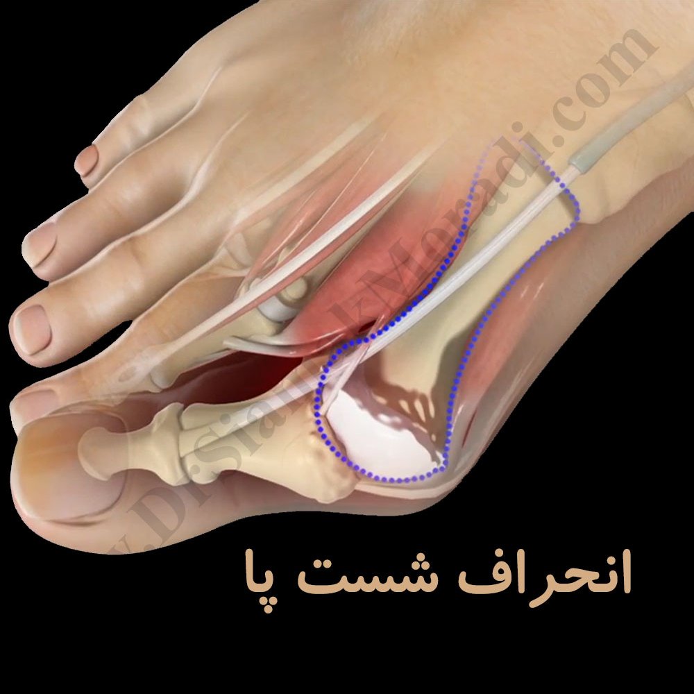 پد  لانگشتی  سیلیکونی  رفع هالوکس والگوس حاوی یک جفت پد فری سایز 