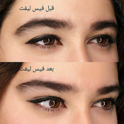کش لیفت ابرو