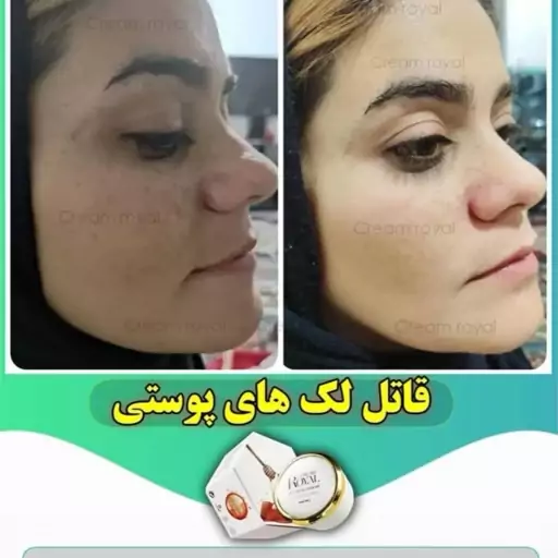 کرم ضدلک قوی رویال باصابون  اصل اصل کافیه یکبارامتحانش کنید مشتری دایمی میشید