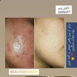 کرم . تضمین پوستی صاف و زیبای شما. 