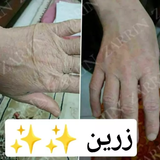 پک کامل جوانساز دست زرین ( روشن کننده و سفید کننده قوی دست)