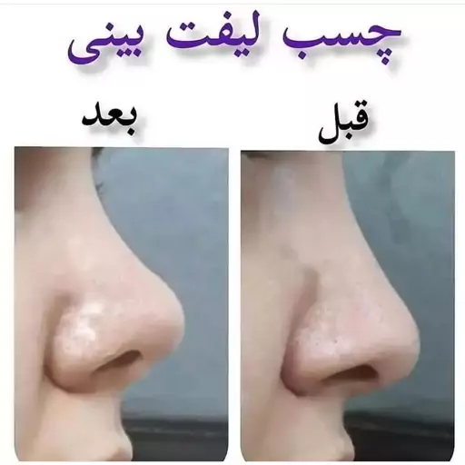 چسب لیفت بینی